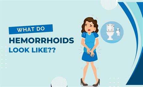 What Do Hemorrhoids Look Like: Types and More